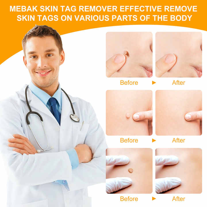 2 In 1 Painless Auto Skin Tag Mole Removal Kit