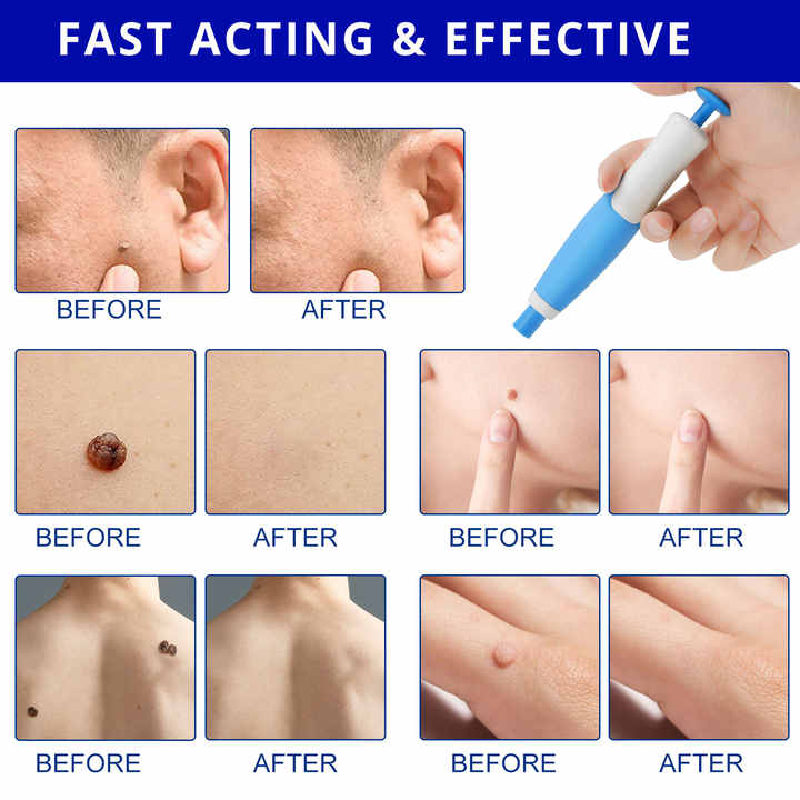 2 In 1 Painless Auto Skin Tag Mole Removal Kit